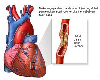 Penyakit Jantung Koroner Bisa Mematikan